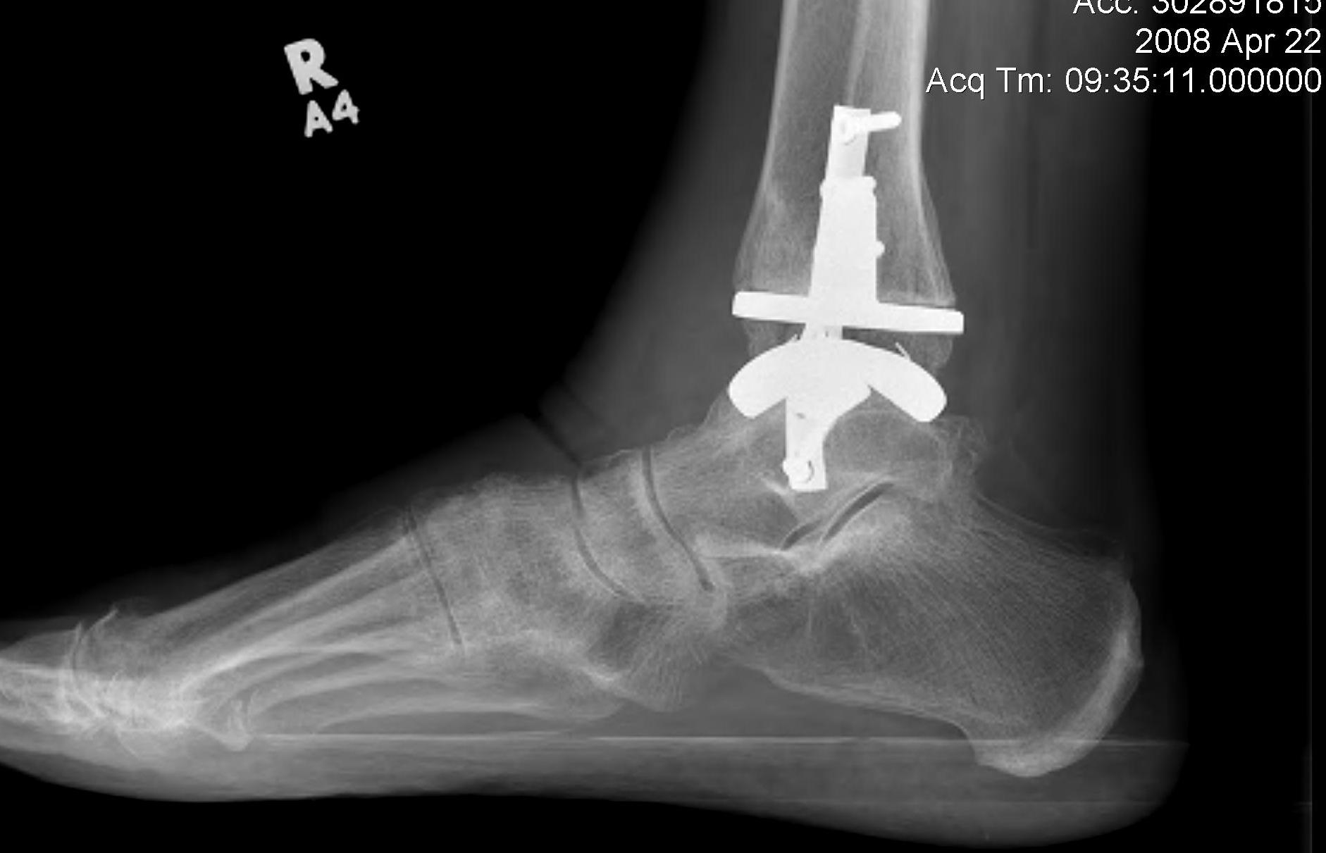 Ankle Arthroplasty Lateral